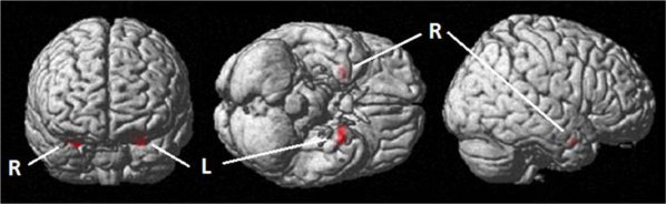 Activation of the bilateral amygdala